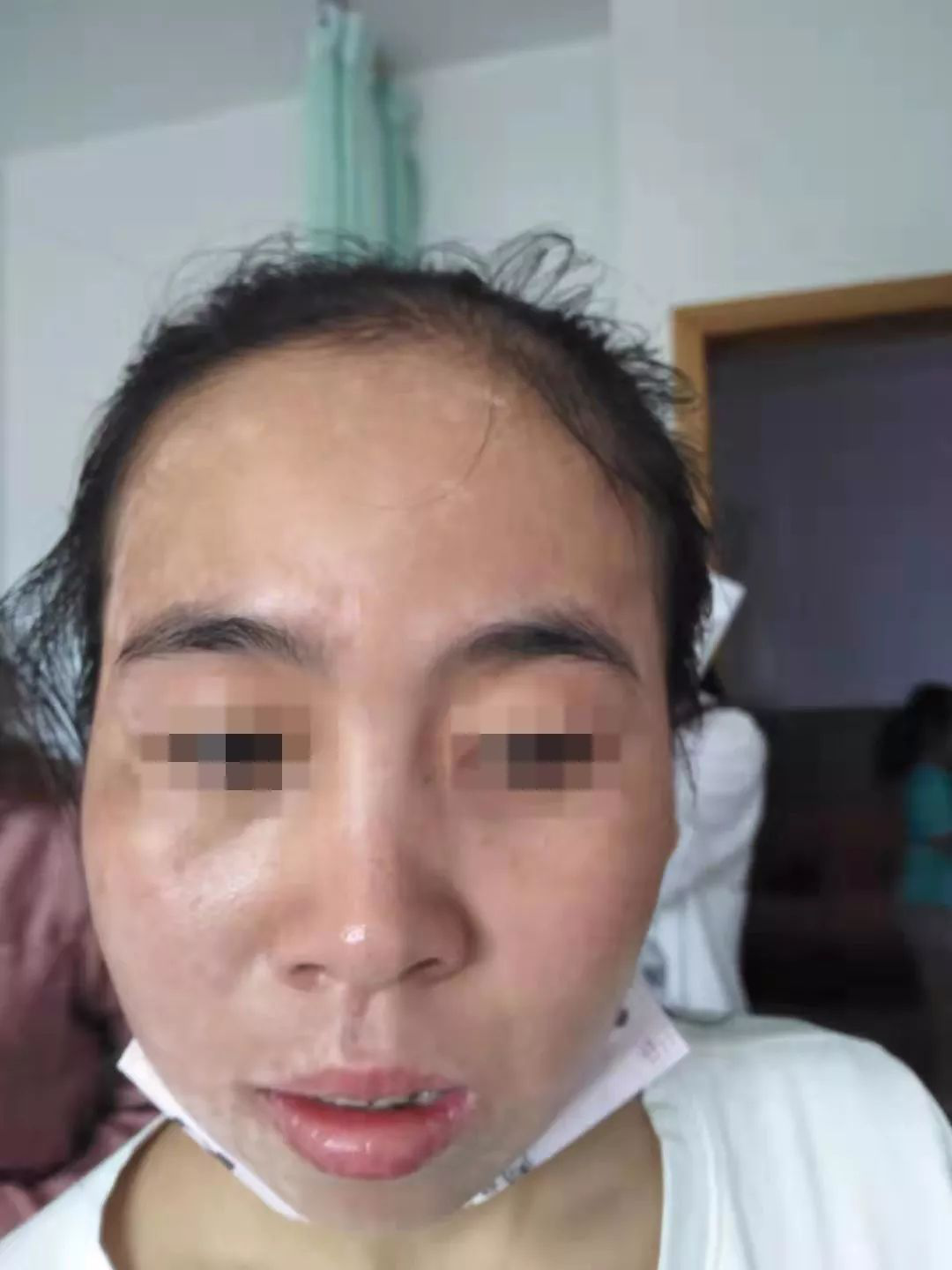 28岁脸上长满白癜风?看看她三个月治疗后现状.